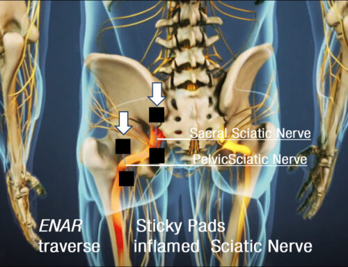 John’s Sciatica Case – ENAR, pads, leads, local